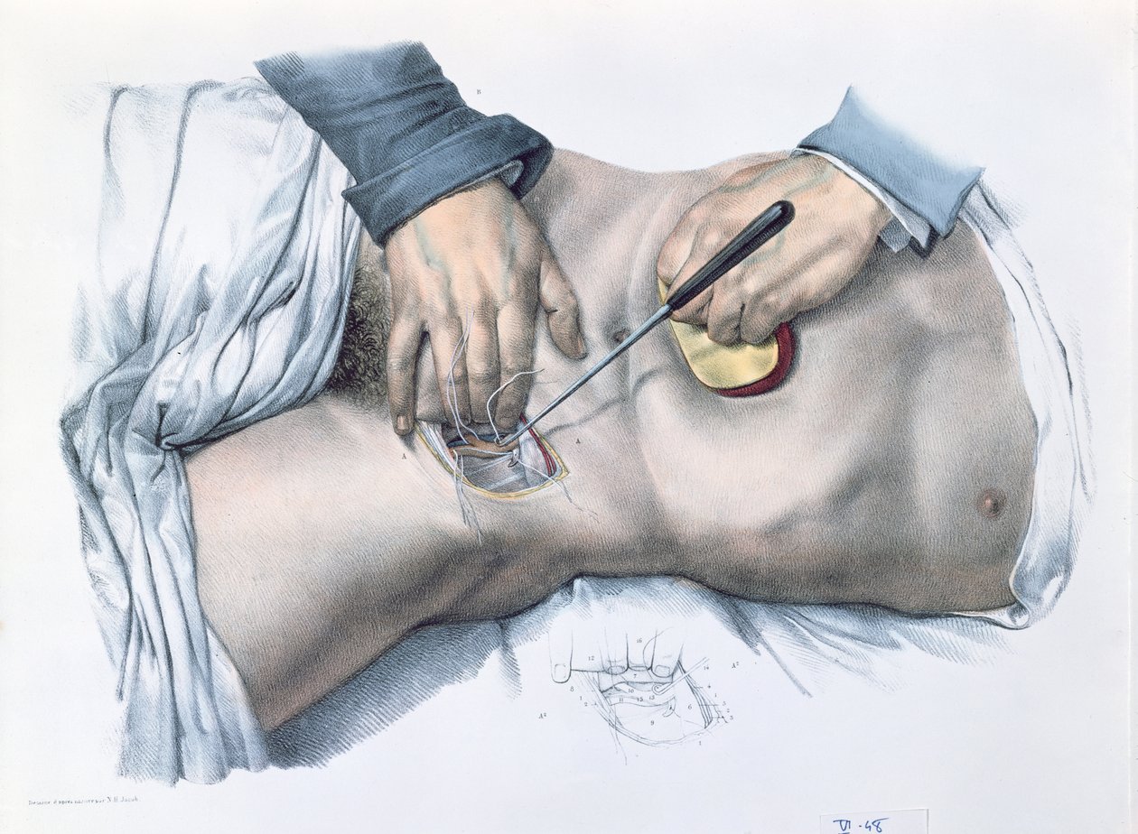 Amarrando uma artéria, placa de "Traço Completo da Anatomia do Homem" por Jean-Baptiste Marc Bourgery (1797-1849) 1866-67 de Nicolas Henri Jacob