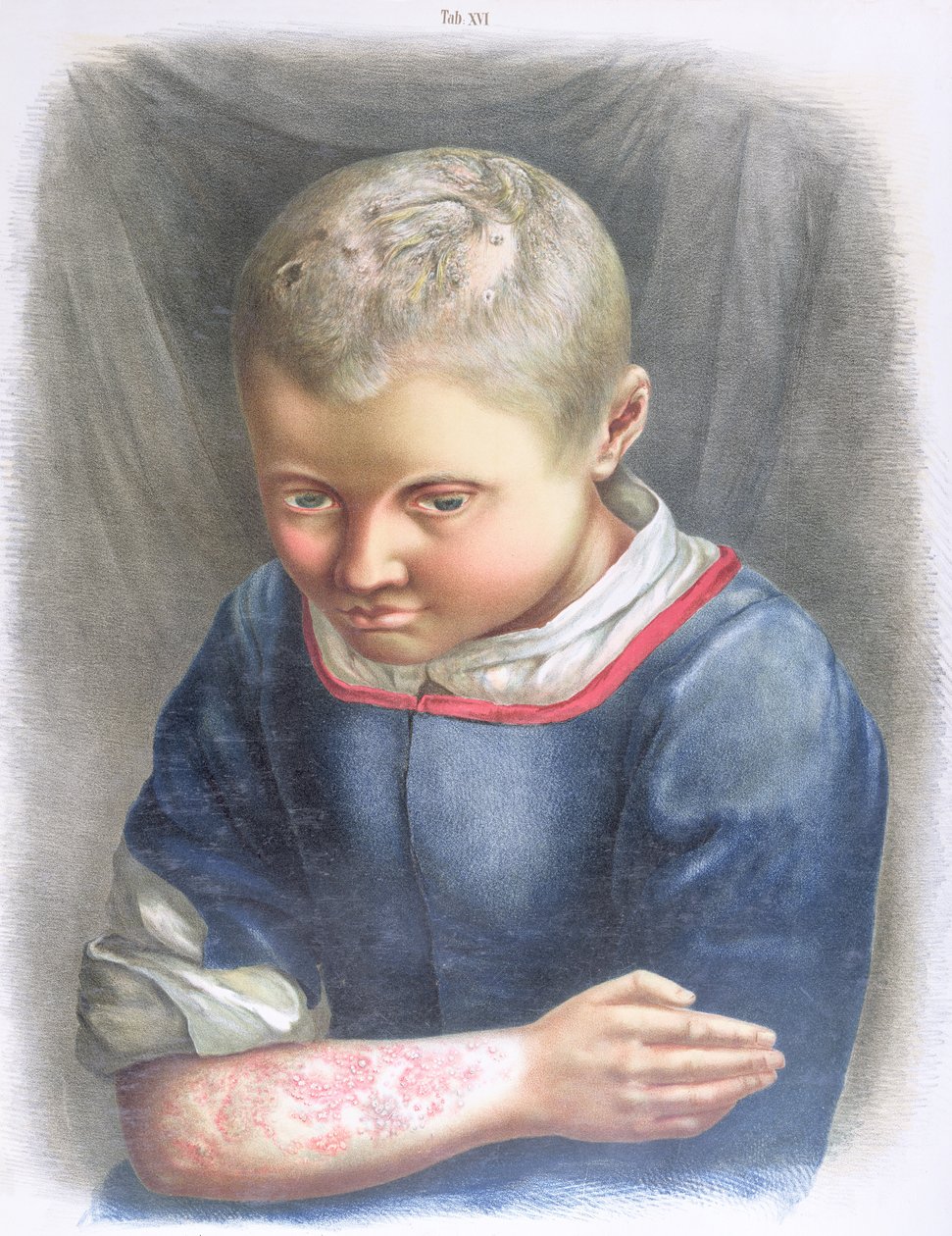 Favus, de um livro de Daniel Cornelius Danielssen (1815-94) 1892 de Norwegian School