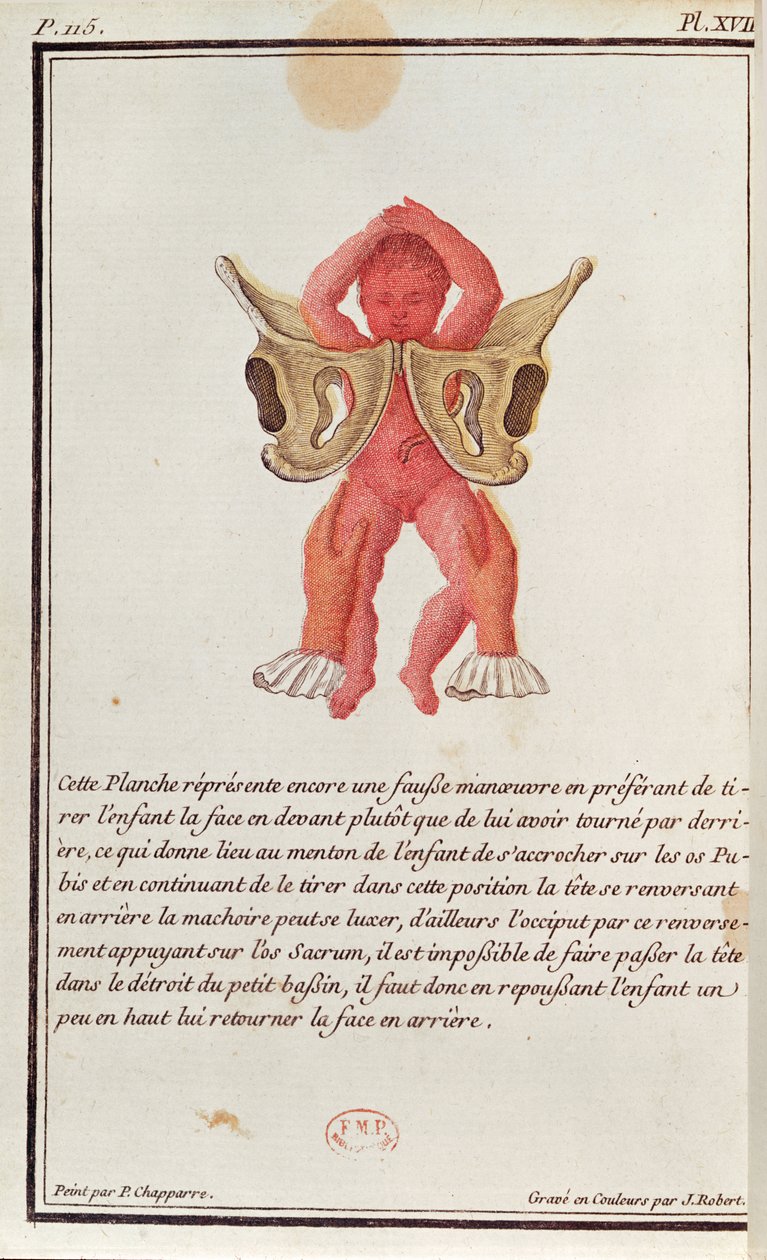 Diagrama transversal de um bebê retirado do útero pelas pernas, de um livro de Madame Angelique Le Boursier du Coudray (1714-94), gravado por J. Robert, 1783 de P. Chapparre