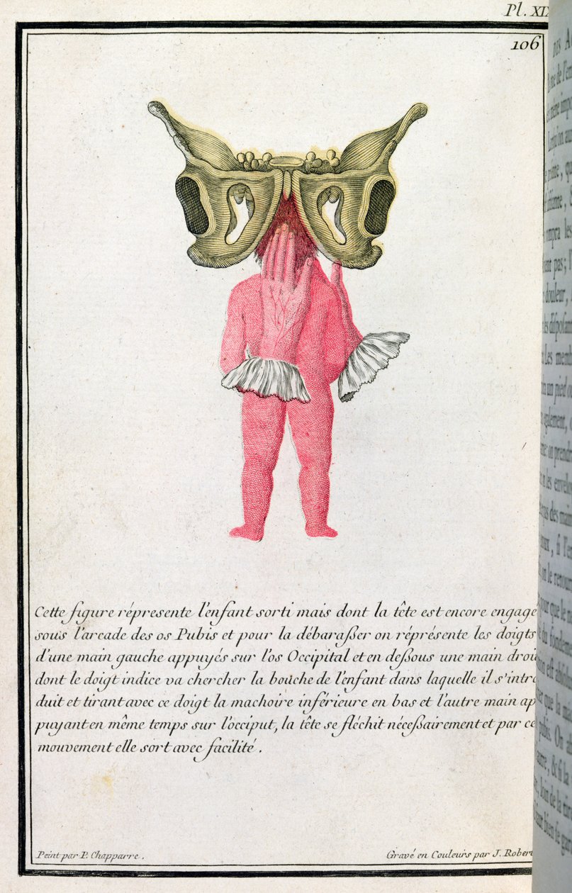 Diagrama transversal de um bebê retirado do útero, de um livro de Madame Angelique Le Boursier du Coudray (1714-94), gravado por J. Robert, 1783 de P. Chapparre