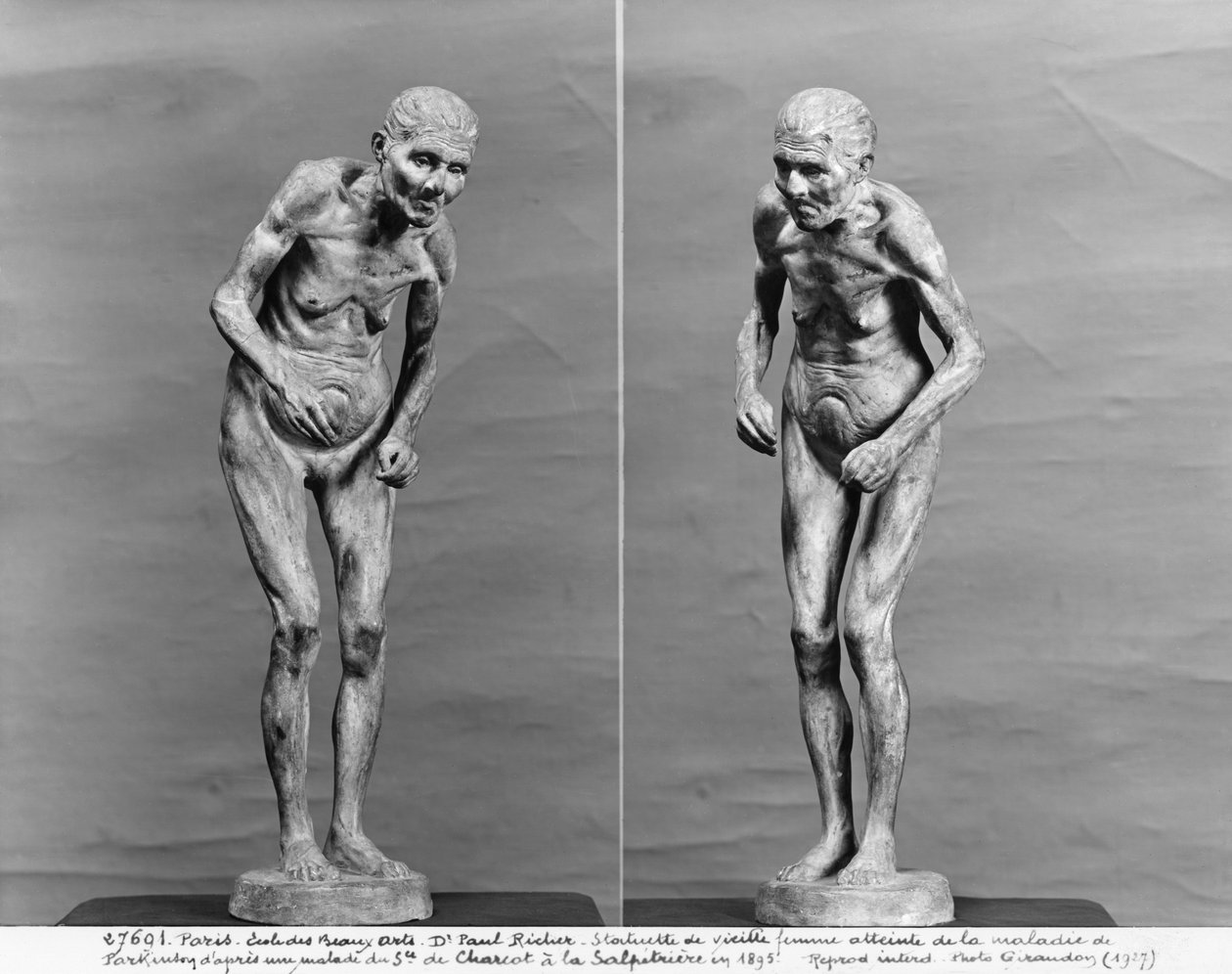 Estatueta de uma mulher idosa com doença de Parkinson, após 1895 (gesso) de Paul Marie Louis Pierre Richer