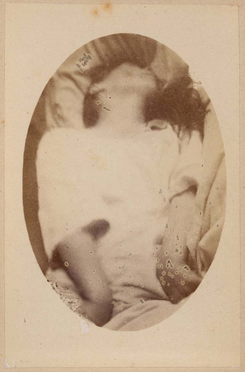 Epilepsia Histérica, Ataque, Fase Epileptoide, Ilustração de &39;Iconografia Fotográfica de La Salpetriere&39; de Bourneville e P. Regnard, Placa XVII, Paris, 1876 (Impressão de Álbuns) de Paul Regnard