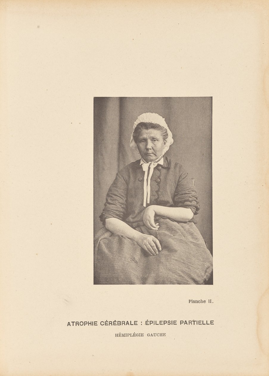 Atrofia cerebral: Epilepsia parcial Hemiplegia esquerda de Paul Marie Léon Regnard