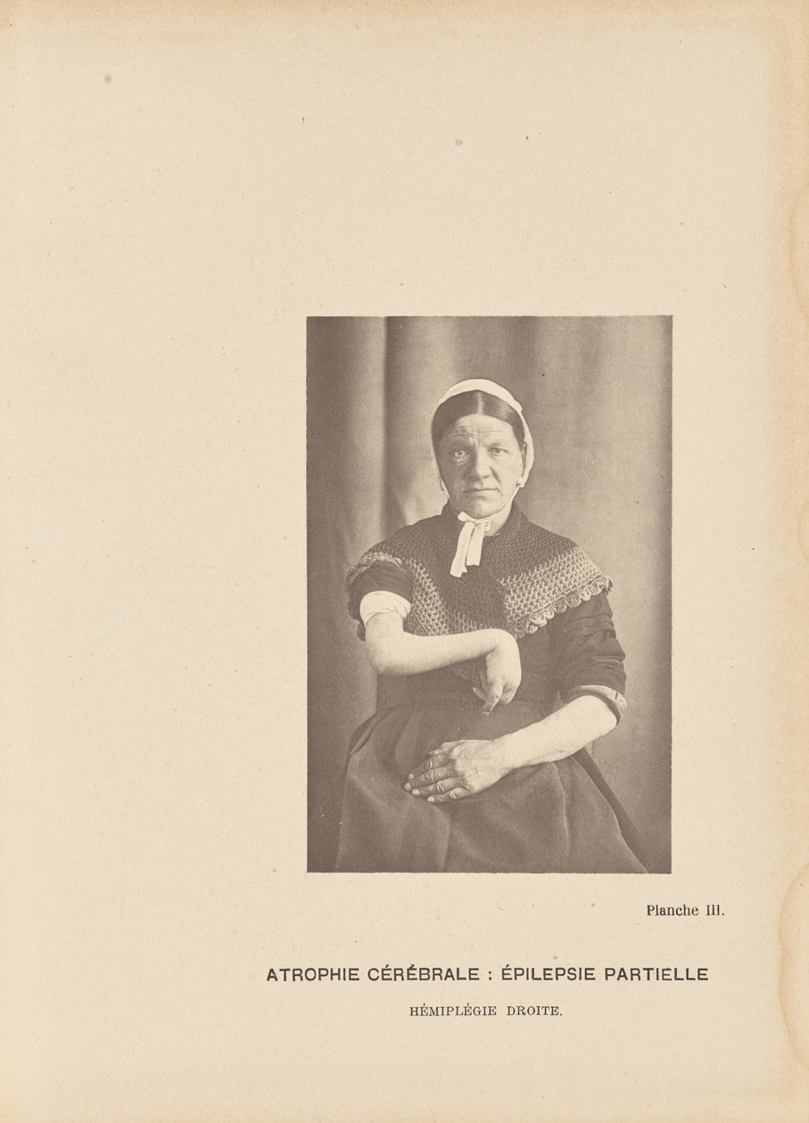 Atrofia cerebral: Epilepsia parcial Hemiplegia direita de Paul Marie Léon Regnard