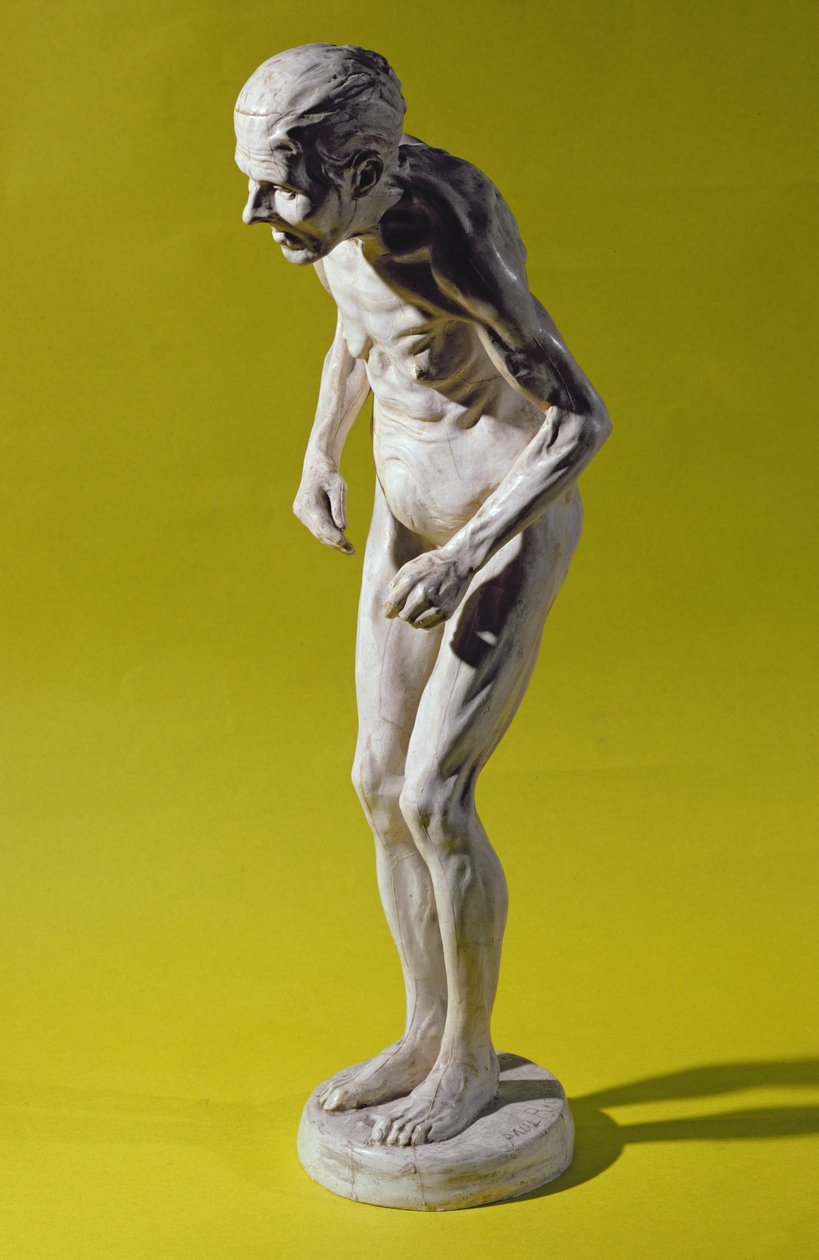 Figura de uma mulher com doença de Parkinson (gesso) de Paul Marie Louis Pierre Richer