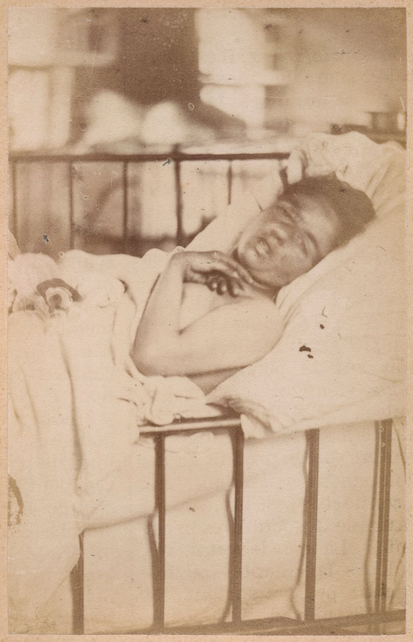 Epilepsia histérica, contração permanente, plana XXVIII de &39;Iconografia fotográfica de La Salpetriere&39; por Bourneville e P. Regnard, Paris, 1876 (impressão albumen) de Paul Regnard
