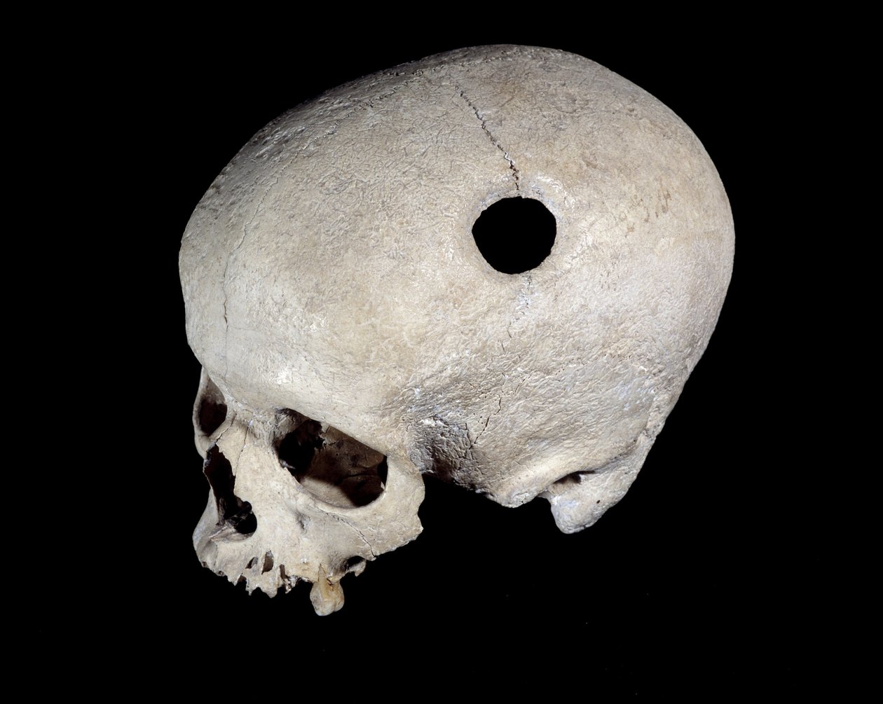 Crânio pré-histórico com traço de trepanação, Museu de Antiguidades Nacionais. de Prehistoric Prehistoric