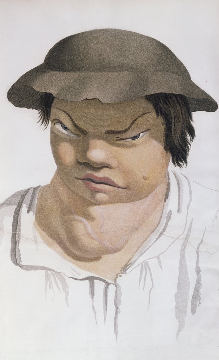 Scrofula endêmica, ilustração de um livro do barão Jean Louis Alibert (1768-1837) de Salvadore Tresca