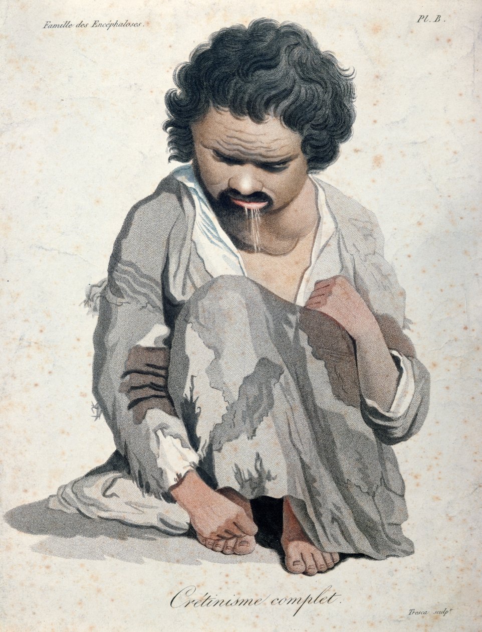 Cretinismo total, de um livro do barão Jean Louis Alibert (1768-1837) de Salvadore Tresca