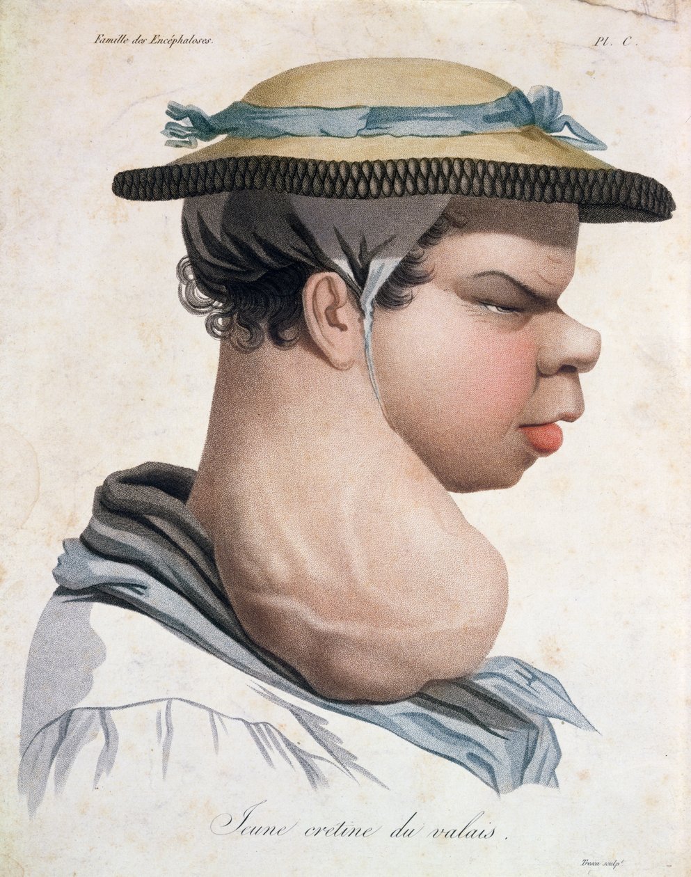 Jovem Cretino de Valais, ilustração de um livro do barão Jean Louis Alibert (1768-1837) de Salvadore Tresca