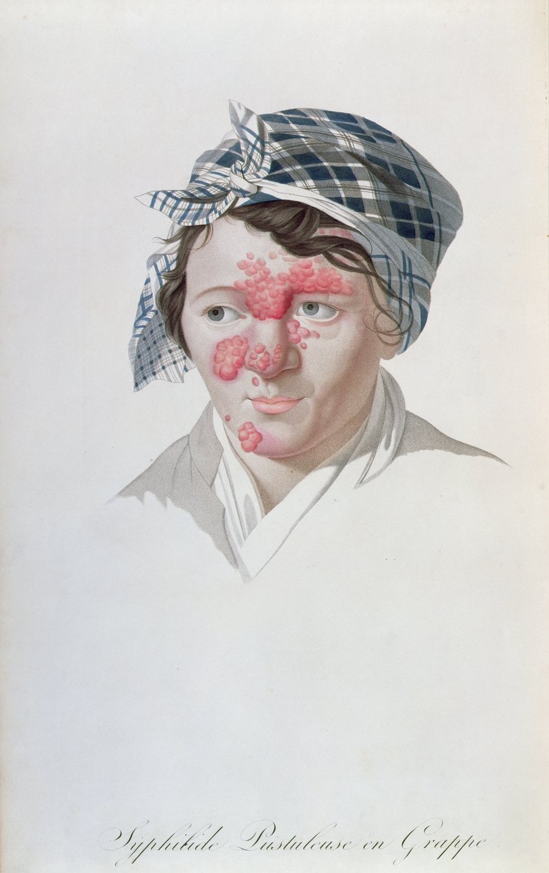 Pústulas de aglomerado sífilis, de um livro do barão Jean Louis Alibert (1768-1837) 1838 de Salvadore Tresca