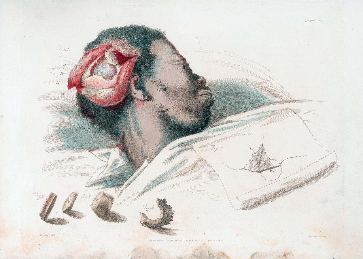 Vista da ferida no crânio após trepanação e remoção do pedaço de osso quebrado no canto inferior esquerdo, 1821 de Thomas Landseer