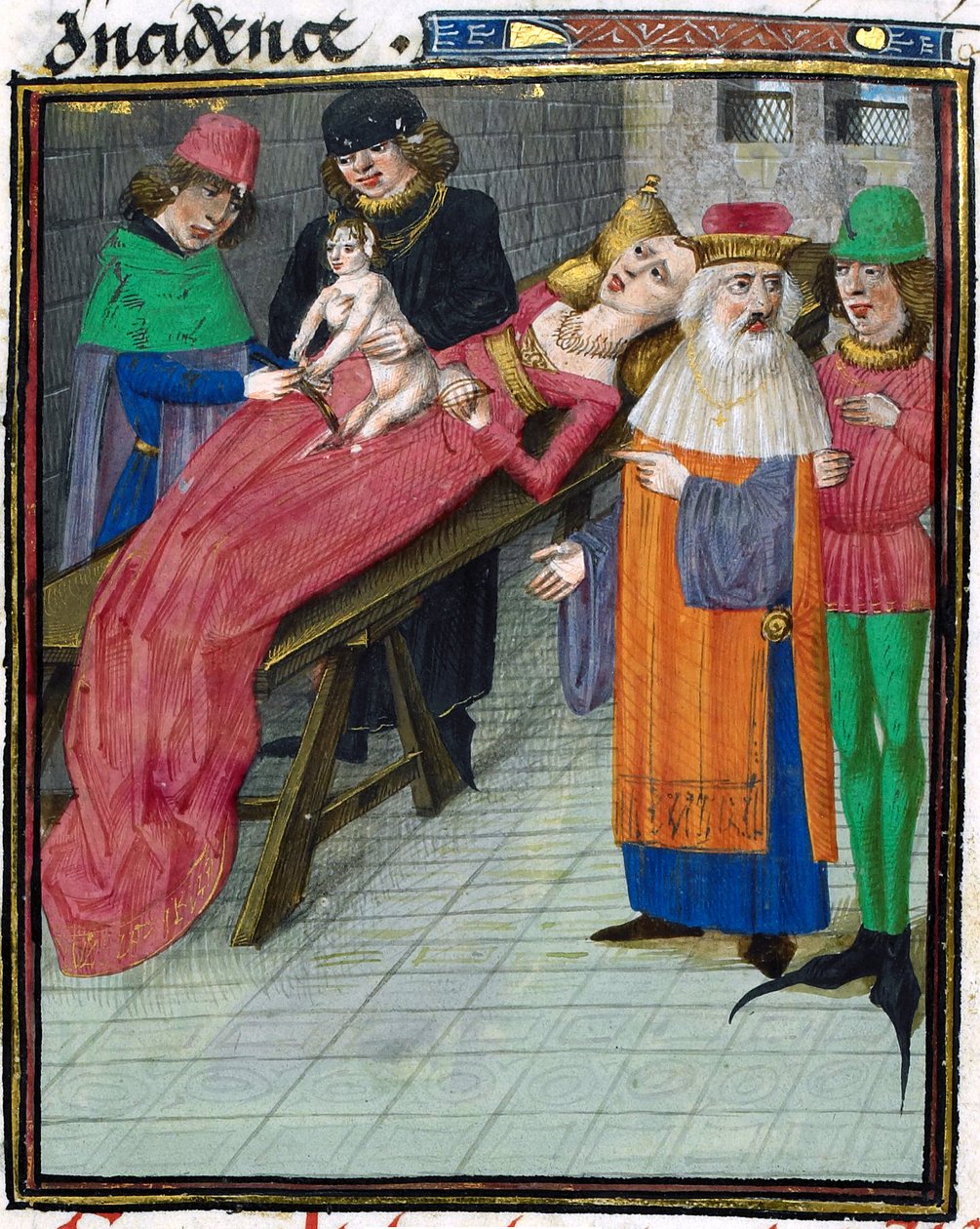 Representação medieval de nascimento de cesariana de Unbekannt Unbekannt