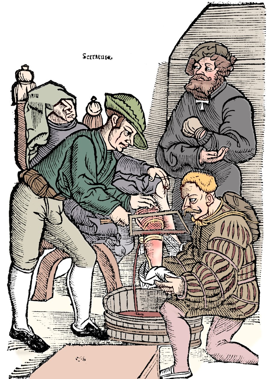Amputação de uma perna sem anestesia, 1593 de Unbekannt