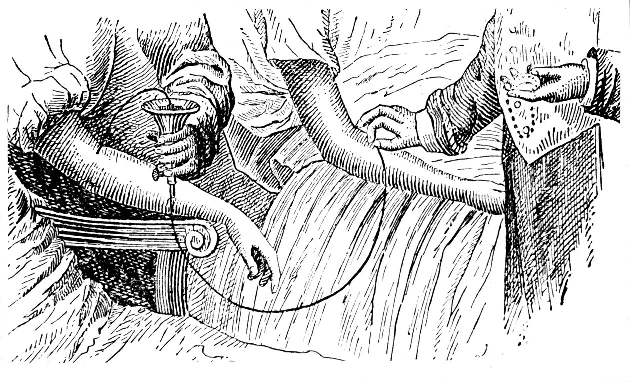 Transfusão de sangue, c1880 de Unbekannt
