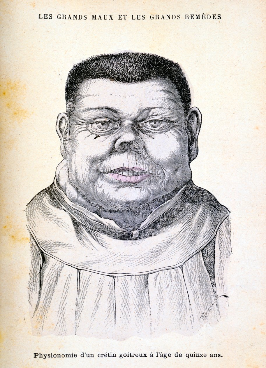 Cretina com 15 anos, c1890 de Unbekannt