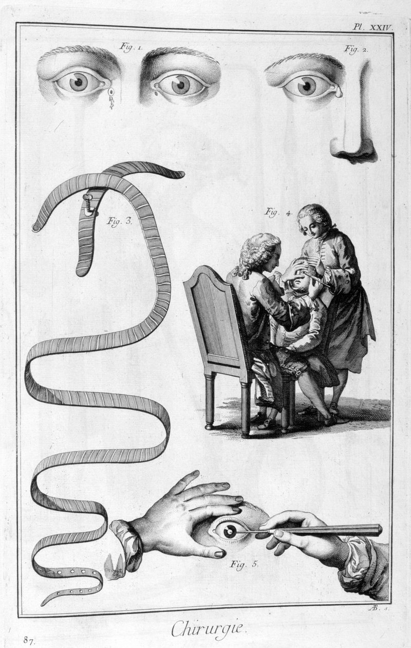 Cirurgia ocular, 1751-1777 de Unbekannt