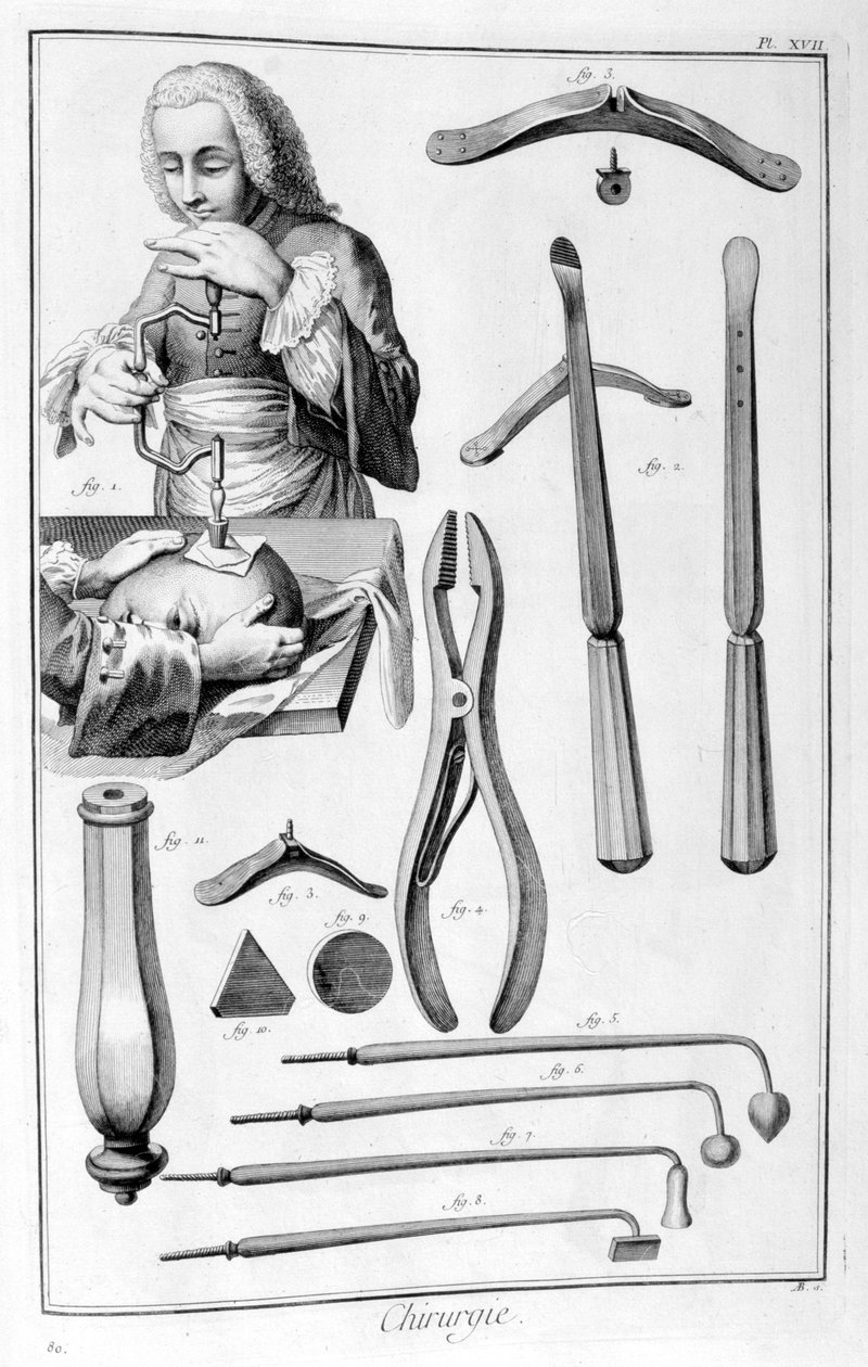 Cirurgia de cabeça, 1751-1777 de Unbekannt