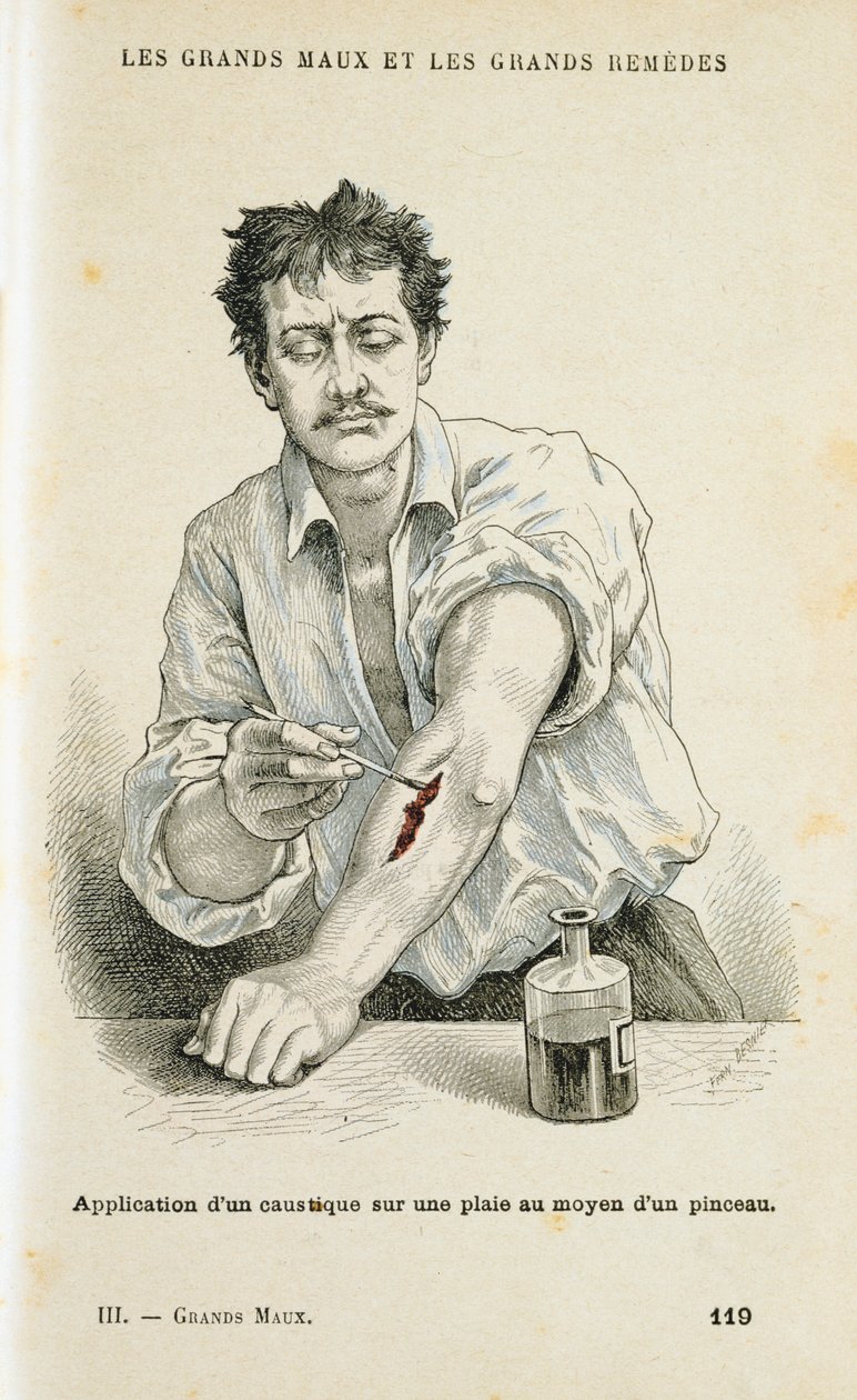 Pintando uma ferida com uma solução anti-séptica, c1890 de Unbekannt