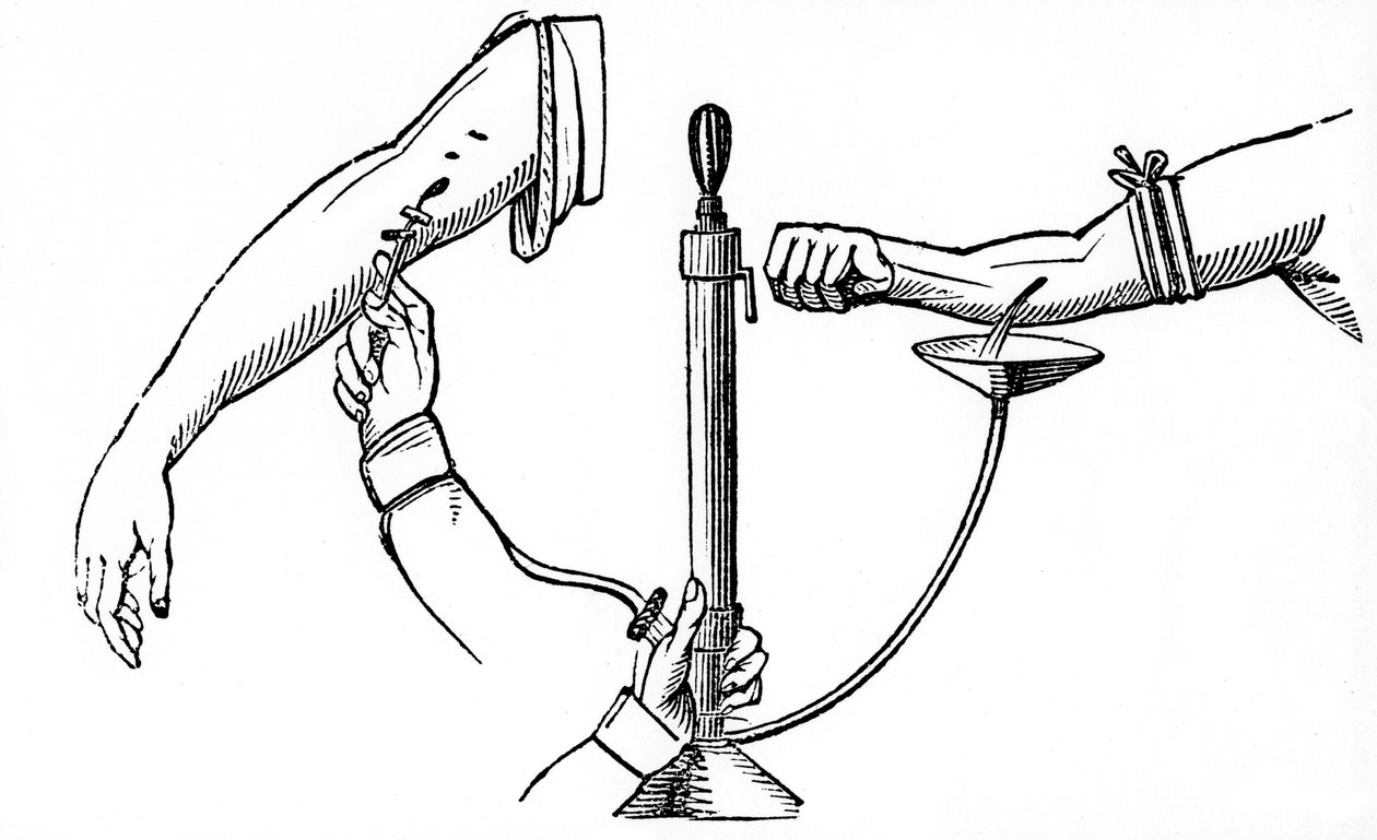 Transfusão de sangue pessoa a pessoa, 1833 de Unbekannt