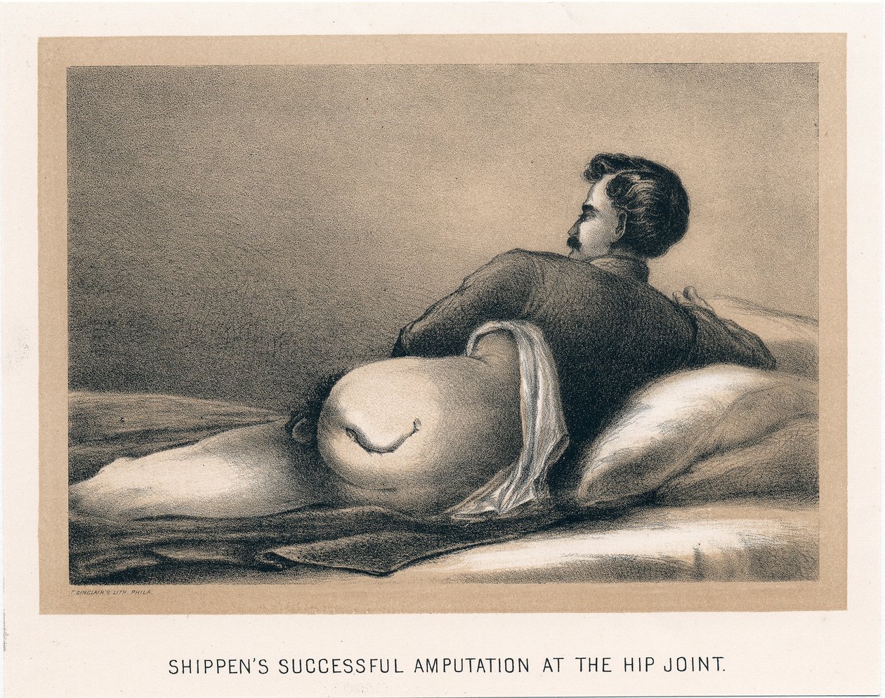 Amputação bem-sucedida de Shippens no quadril, Guerra Civil Americana, 1865 de Unbekannt