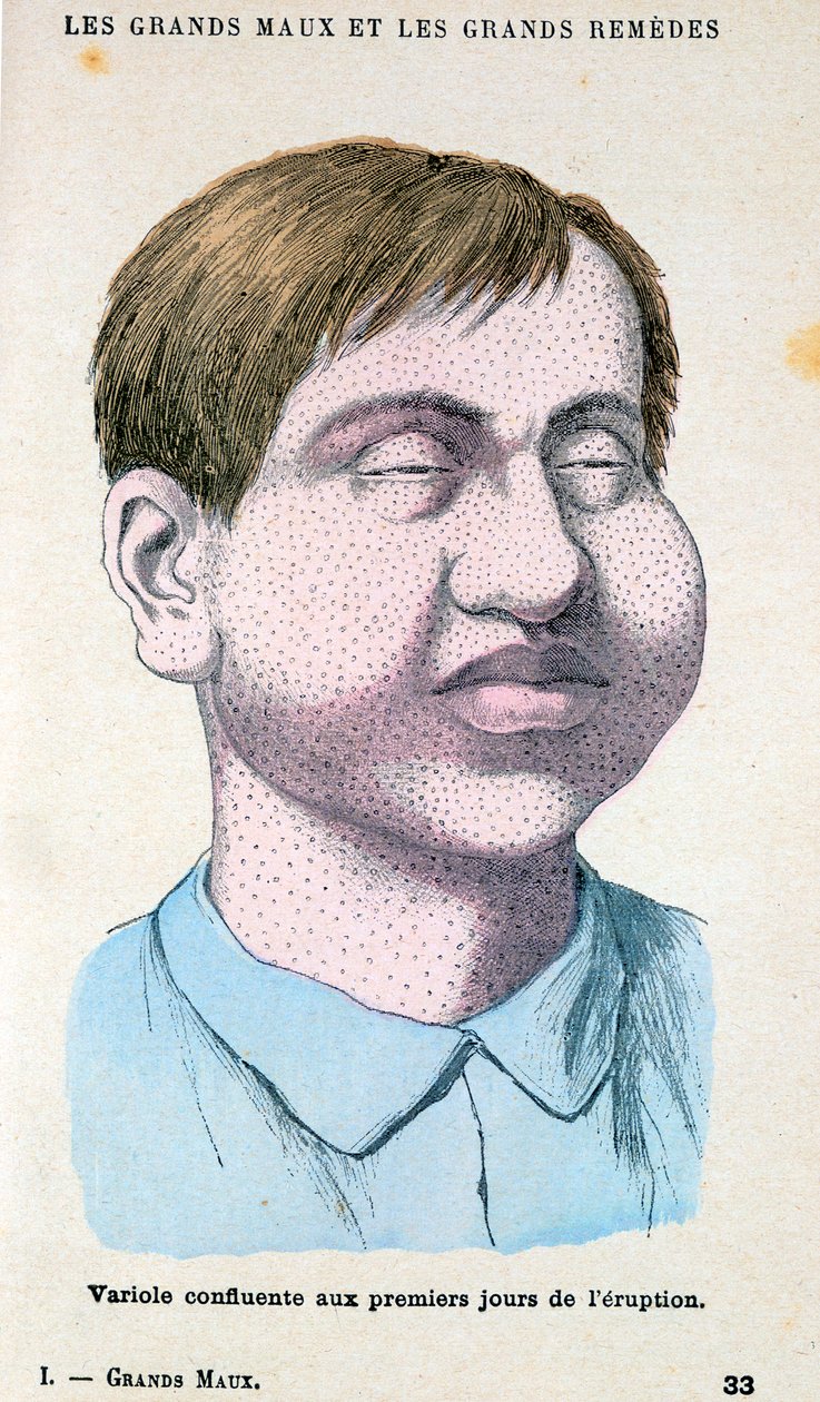 Vítima de varíola, c1890 de Unbekannt