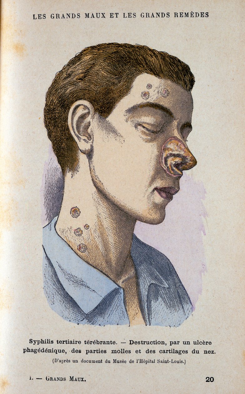 Sintomas da fase terciária da sífilis, século c19 de Unbekannt