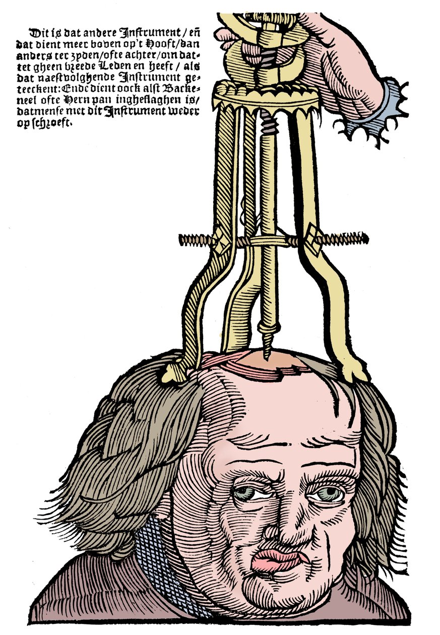 Trefinação, 1593 de Unbekannt