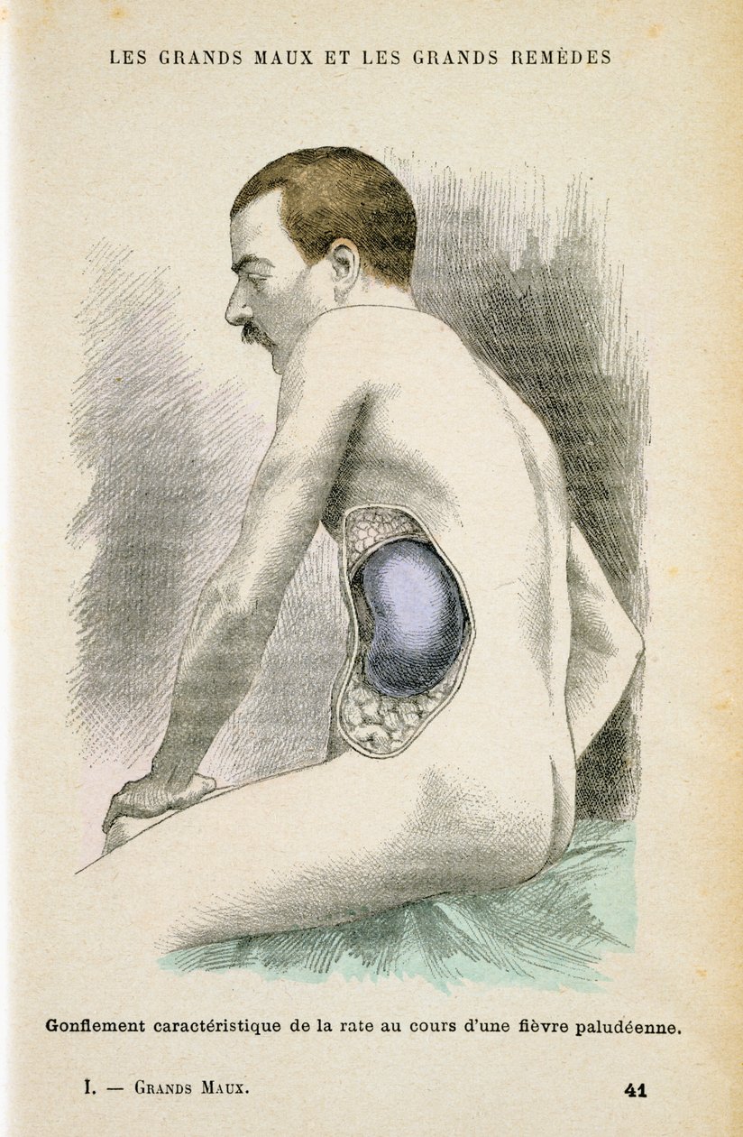 Baço aumentado típico de um paciente com malária, c1890 de Unbekannt