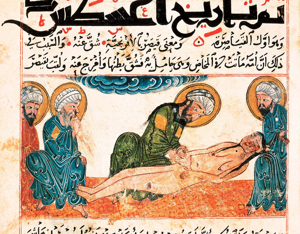 Representação do parto cesáreo. Miniatura retirada de um manuscrito de medicina de Abu Raihan Al-Biruni (ou Alberuni) (973-1048), intelectual e cientista persa, fólio 161. de Unbekannt