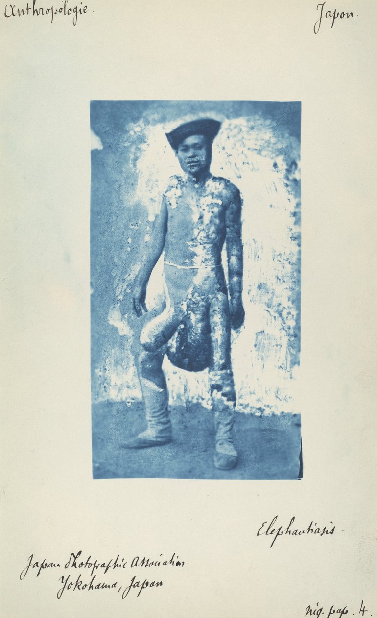 Elefantíase de Unknown 19th Century