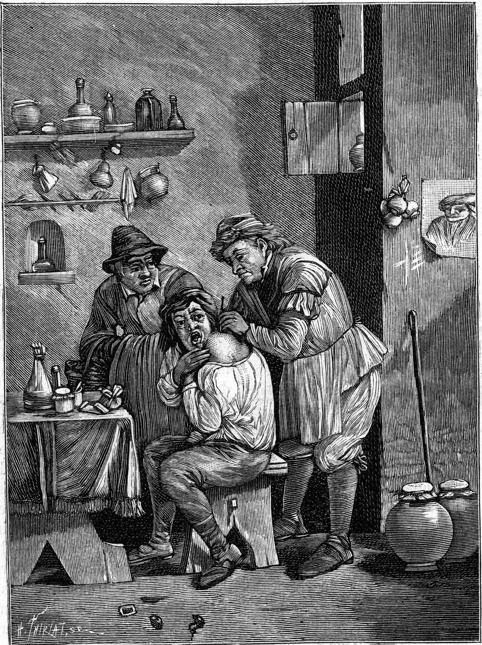 Um cirurgião charlatão no século 18, examinando uma lesão no ombro. (A partir de uma gravura do tempo). Gravura em "La Nature: Revue des sciences et de leurs applications aux arts et a l