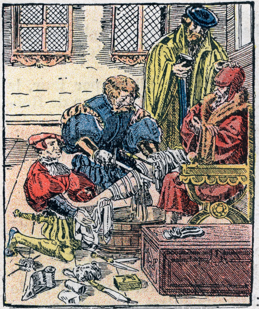 Amputação de uma perna no século XVI. de Unknown artist