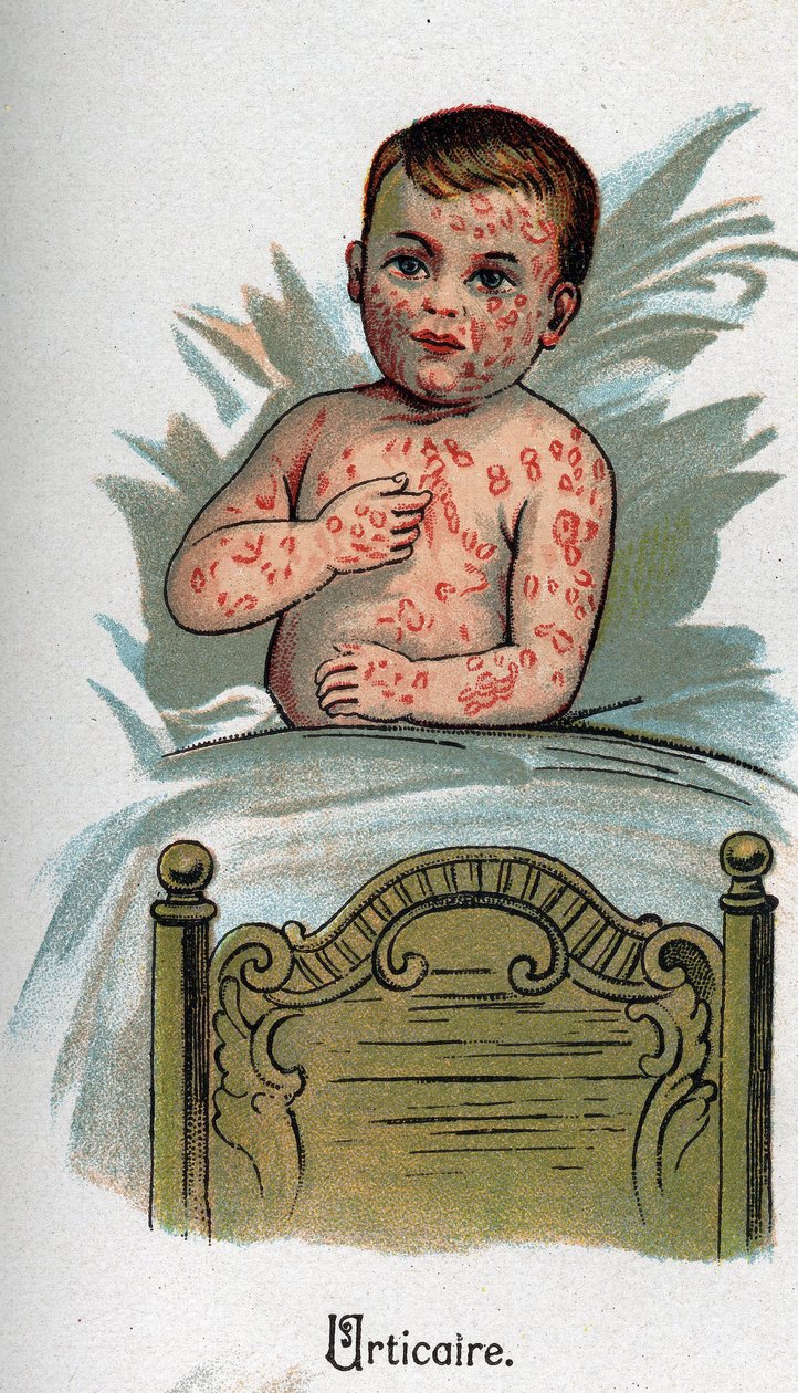 Doenças das crianças: Urticária. In" The new natural medicine" de F.E. Bilz. de Unknown artist