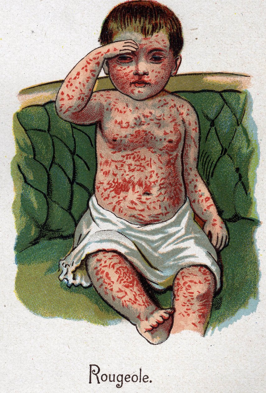 Doenças das crianças: Sarampo. In" The new natural medicine" de F.E. Bilz. de Unknown artist