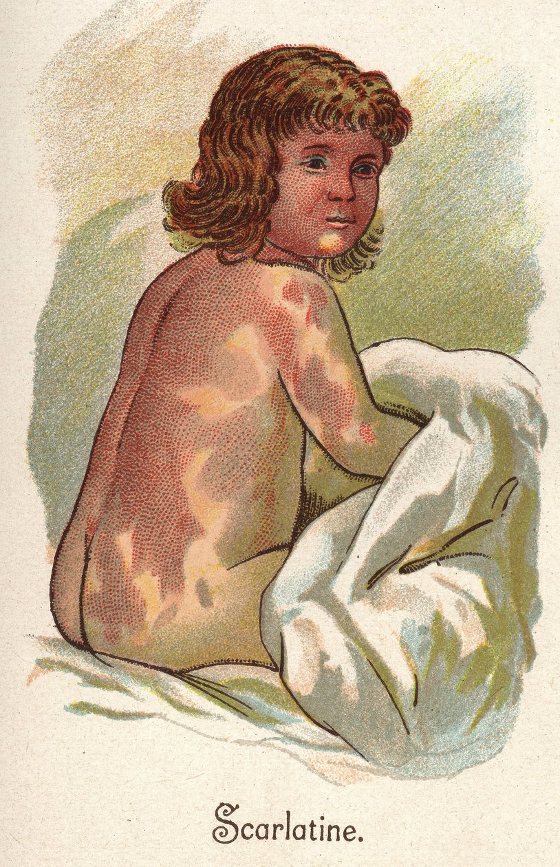 Doenças das crianças: Febre escarlate. In" The new natural medication" de F.E. Bilz. de Unknown artist