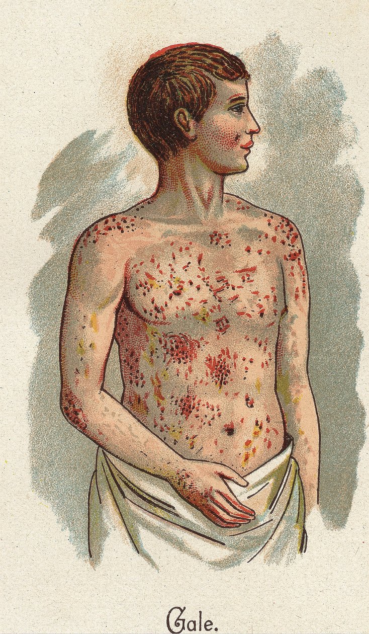 Doenças das crianças: A sarna. In" The new natural medication" de F.E. Bilz. de Unknown artist