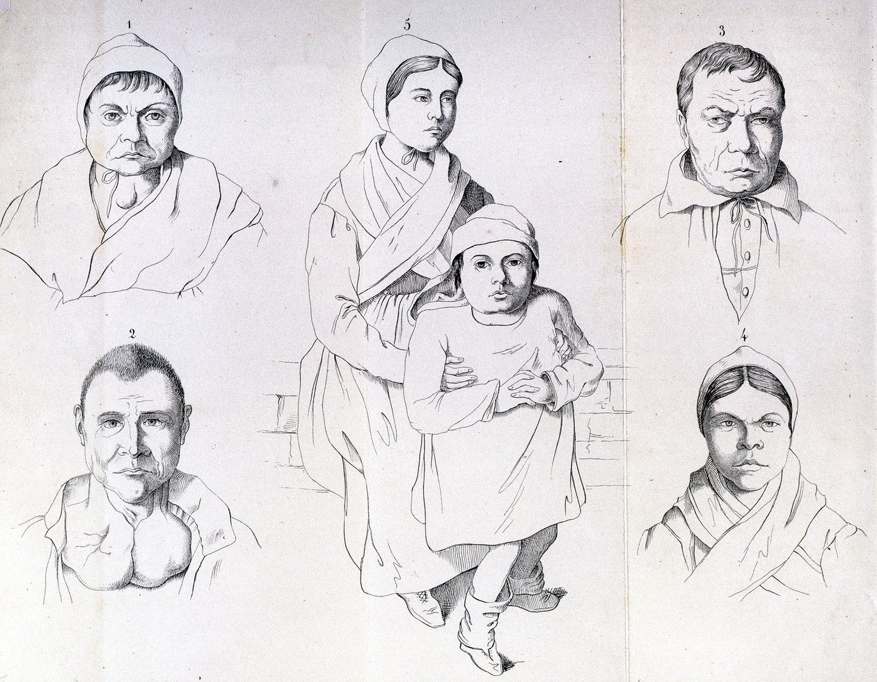 Considerações sobre as causas do cretinismo endémico de Morel. de Unknown artist