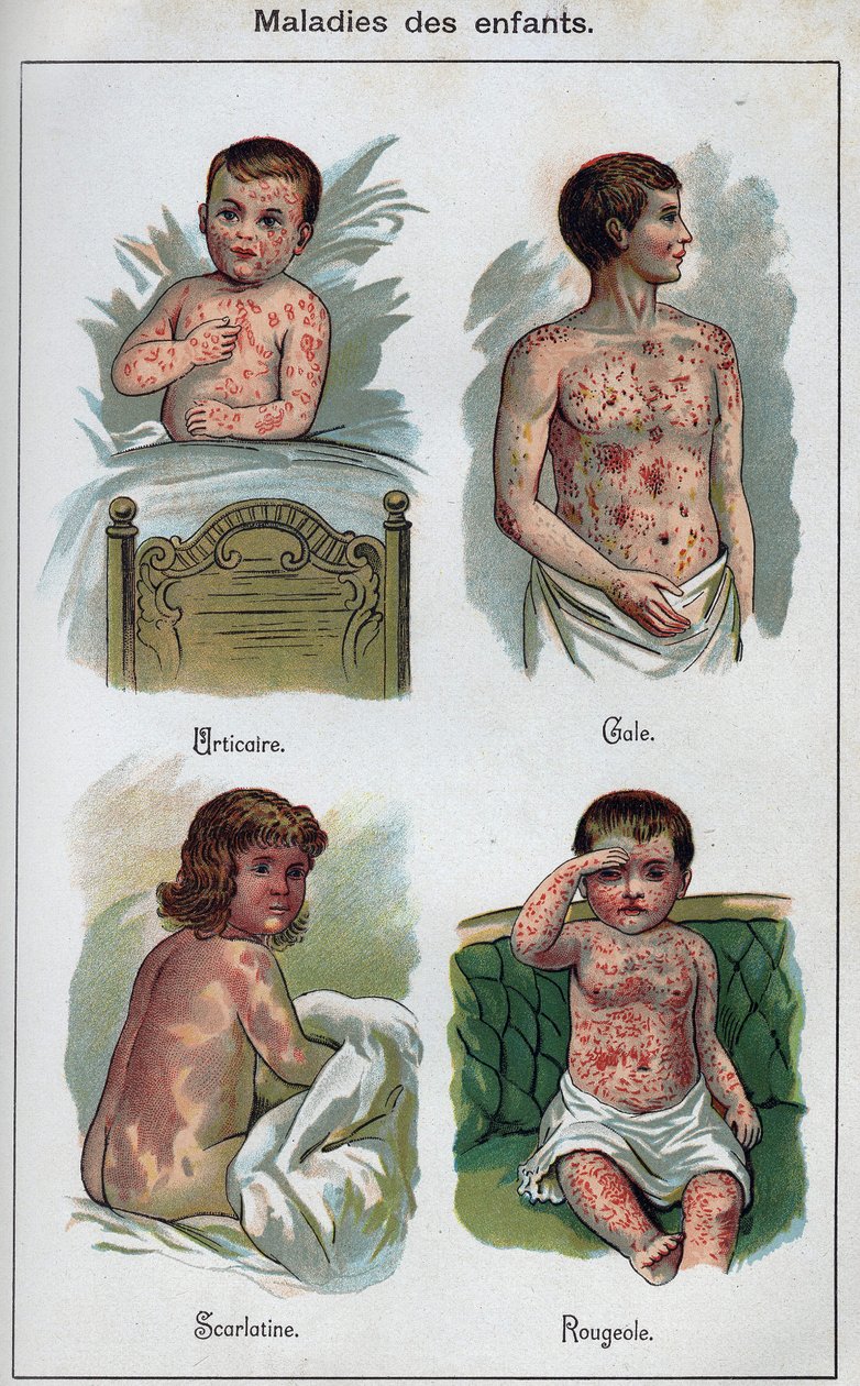 Doenças de crianças: Urticária, sarampo, sarna, escarlatina. In" The new natural medication" de F.E. Bilz. de Unknown artist