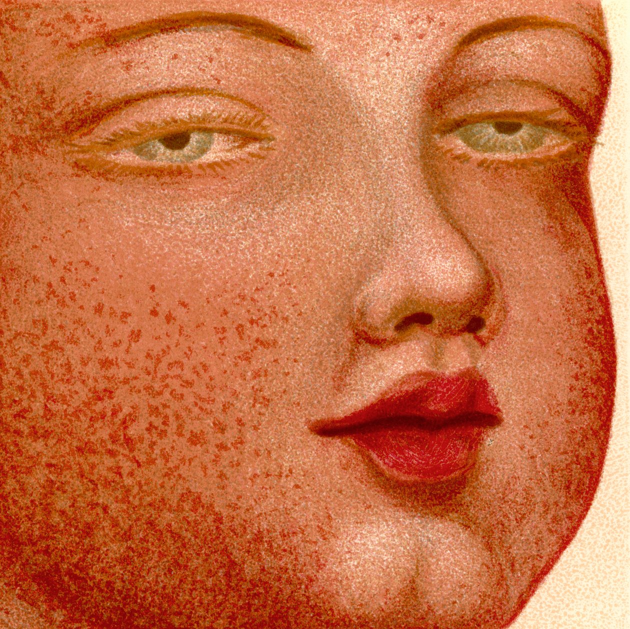 Eruptive Fevers: Scarlatina ou Febre Escarlate de Unknown artist