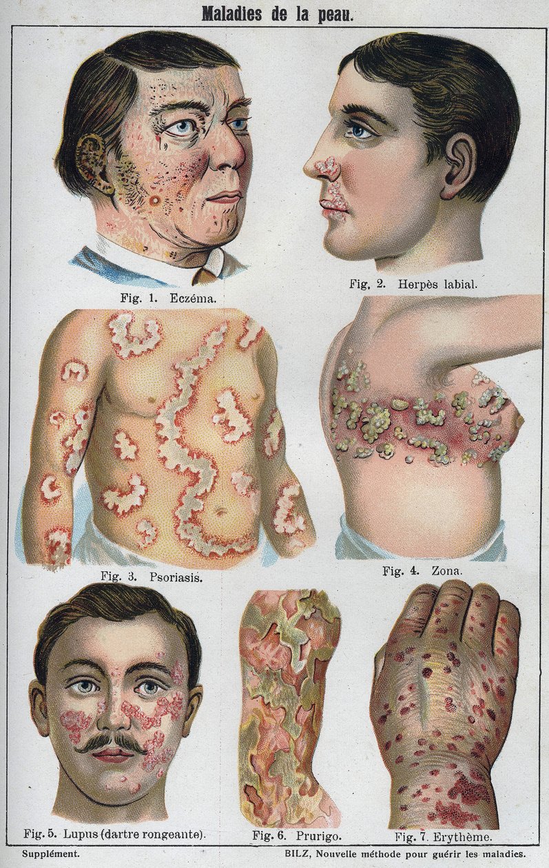 Doenças de pele: Eczema, herpes labial, psoríase, herpes zóster, lábio, prurigo, eritema". A nova medicação natural" de F.E. Bilz. de Unknown artist