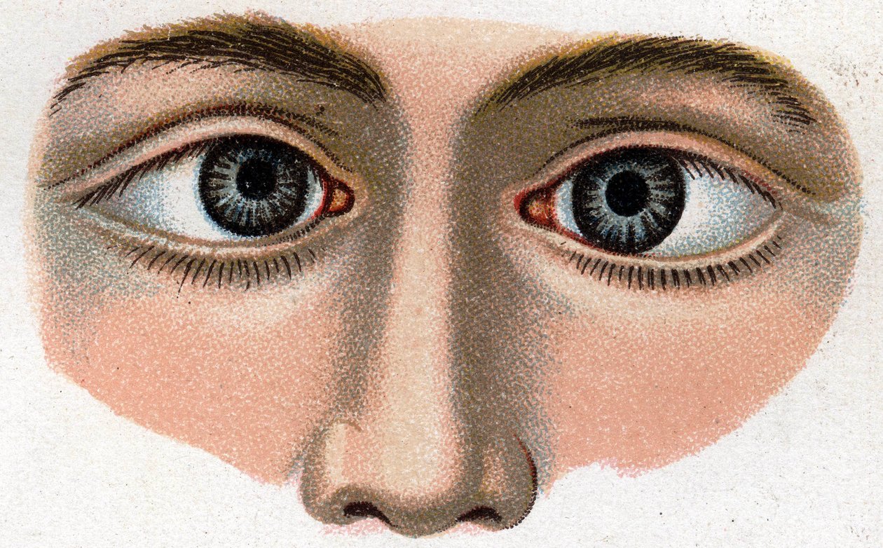 Strabismus convergem. "A nova medicação natural" de F.E. Bilz. de Unknown artist
