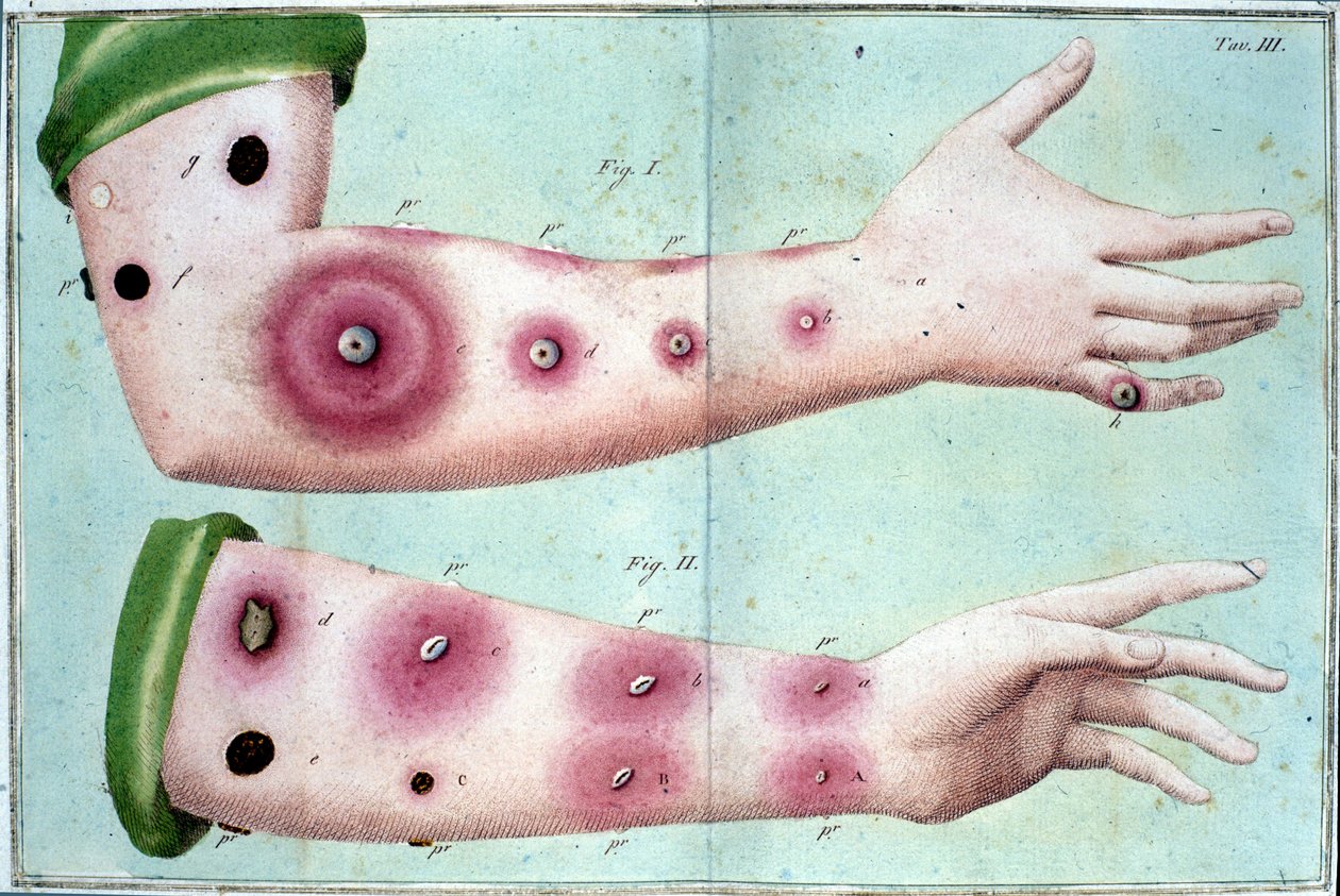 Sintomas de varíola que causam um surto de pústulas na pele. Placa médica do "Vaccination Treat" de Luigi Sacco, Milão de Unknown artist