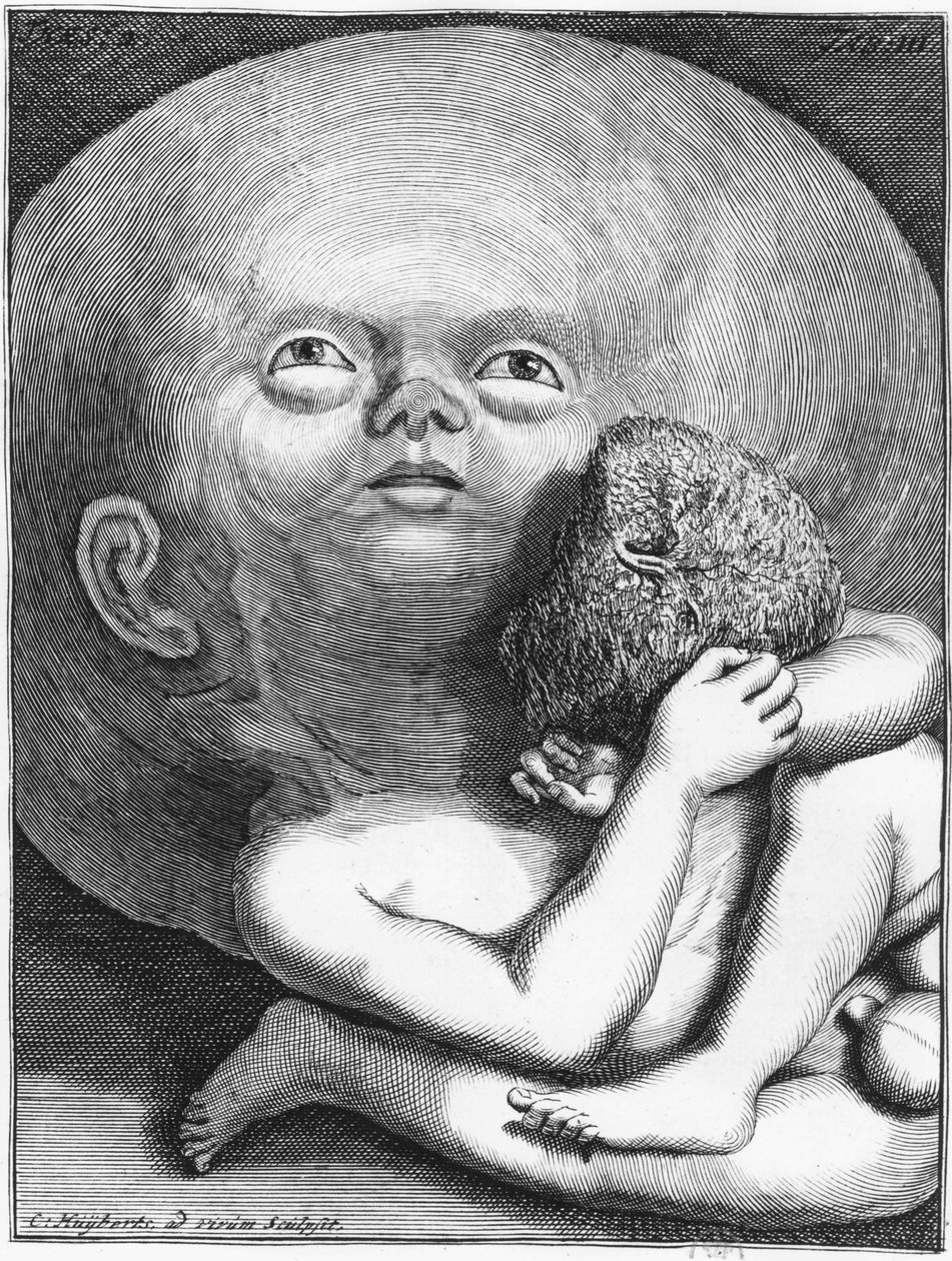 Monstro: Antropologia hidrocefálica infantil - grav., n.d., final do século XVIII de Unknown artist