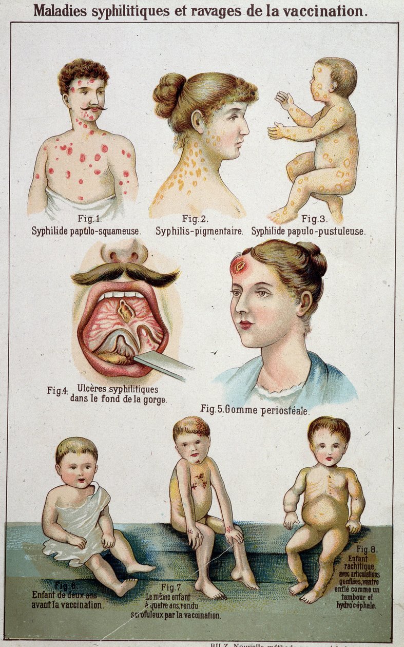 Placa ilustrando os diferentes dormitórios das doenças sifilíticas e os perigos da vacinação - na medicina natural de Bilz, no final do século XIX. de Unknown artist