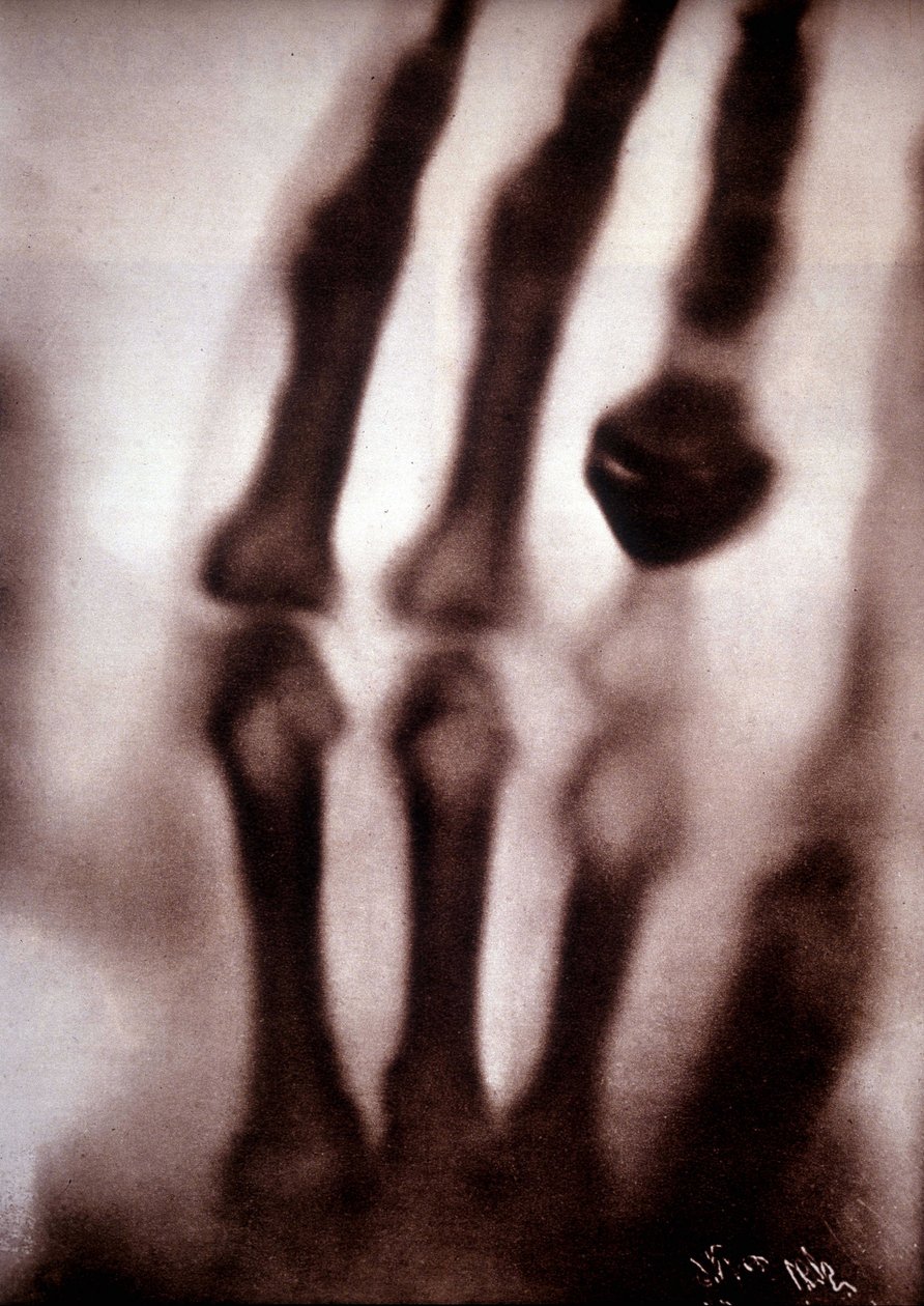 Raios Roentgen (Rontgen) ou Raios X Primeira fotografia: a mão da mulher de Roentgen. 22/12/1895. de Unknown artist