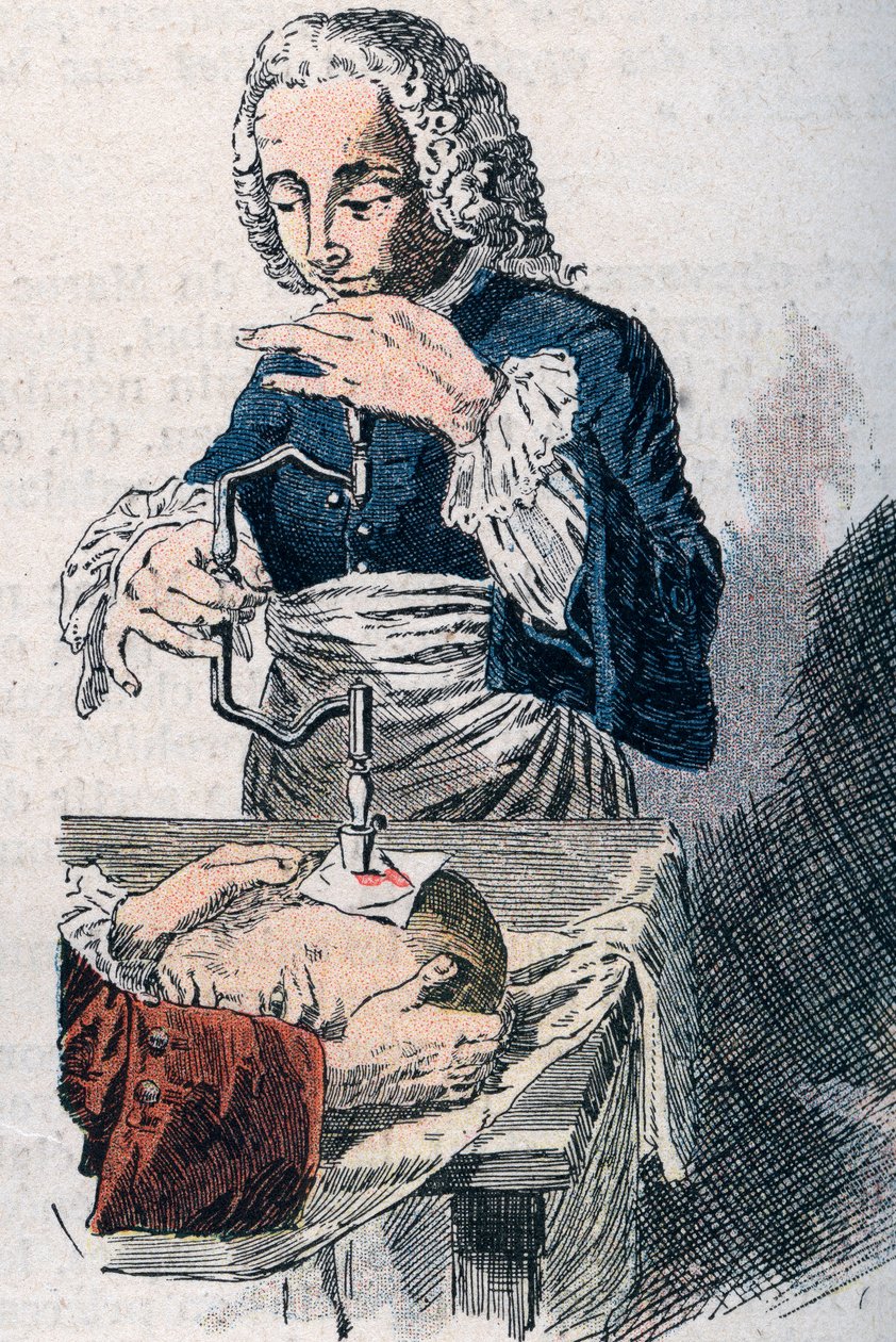 A Trepanação. A impressão do século XVIII. de Unknown artist