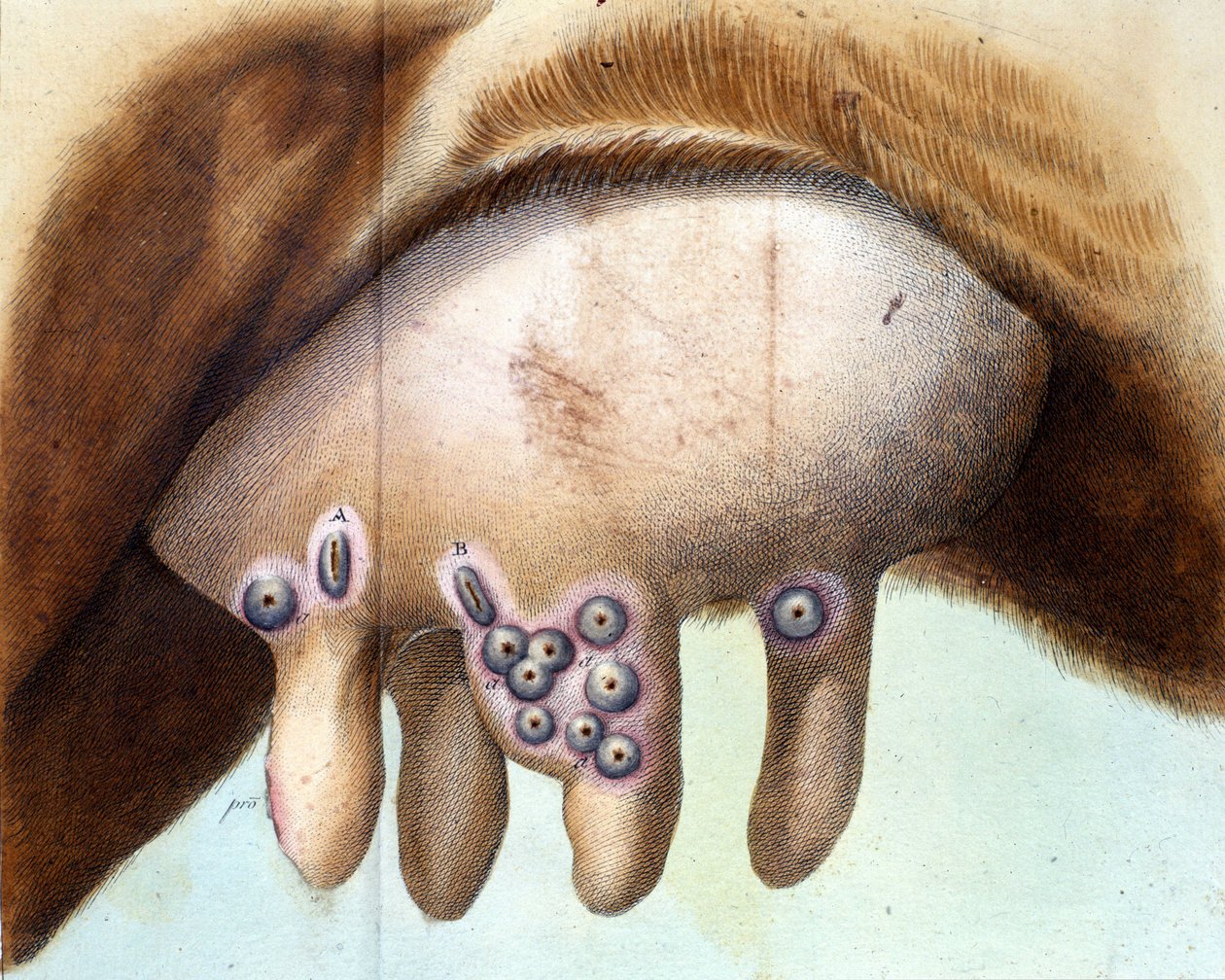 O peito de vaca usado para inocular a vacina contra a varíola por Luigi Sacco (1769-1836) em janeiro de 1801. Placa médica de "Vaccination Treat", de Luigi Sacco, Milão de Unknown artist