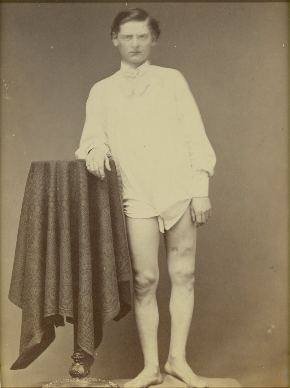 Soldado da Guerra Civil Ferido (Soldado Charles Westerfield, Exército Médico Museu Specimen No. 4278), abril de 1865, 1865 (albumen imprimir) de William Abraham Bell