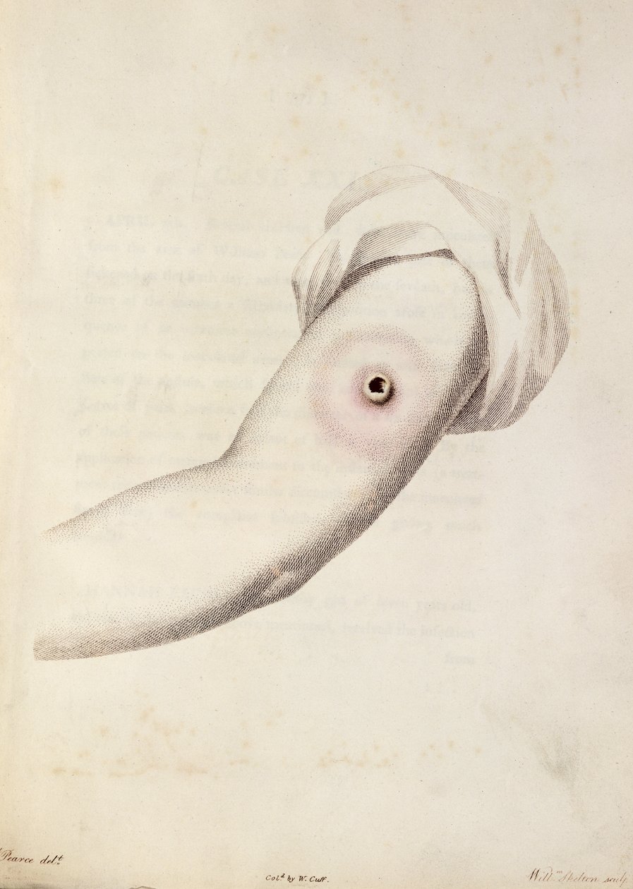 Pústula de varíola bovina em um braço, de "Um Inquérito sobre as Causas e Efeitos das Variolae Vaccinae" por Edward Jenner (1749-1823) gravado por Pearce, c.1800 de William Skelton